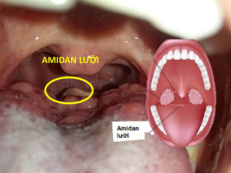 Tham khảo hình ảnh viêm amidan đáy lưỡi