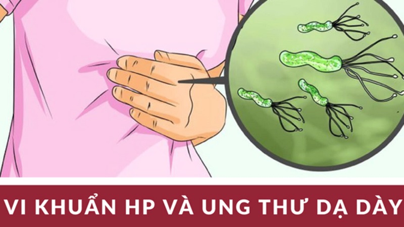 Vi khuẩn HP có thể gây ung thư dạ dày