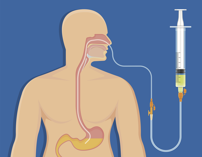 Người mắc bệnh lý nặng hoặc bị tai nạn, hôn mê có thể được thực hiện đặt sonde dạ dày